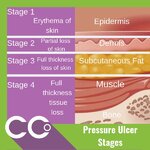 Pressure Ulcer Stages- .jpg