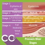 Pressure Ulcer Stages- .webp