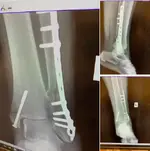cobuzzi fracture.webp cobuzzi fracture.webp